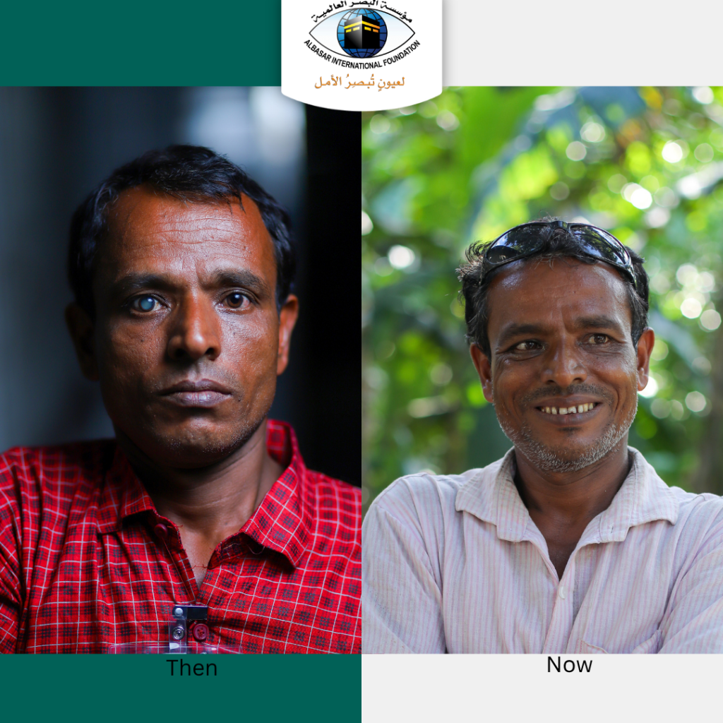 Patient before and after cataract surgery
