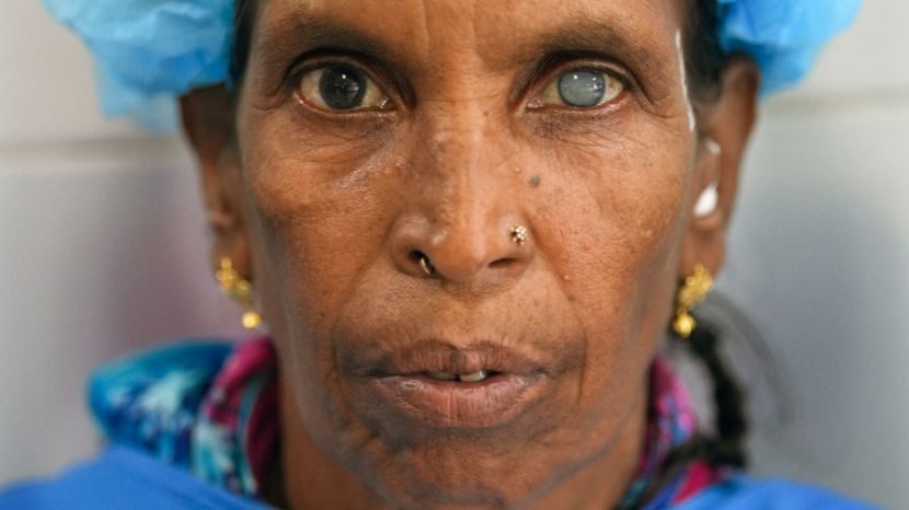 Close-up of a woman showing a cloudy cataract in her left eye.